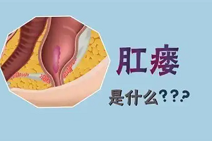 男性肛瘘怎么办？