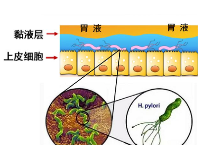 幽门螺旋杆菌如何影响胃酸分泌？