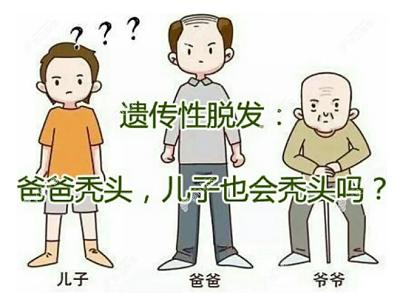 遗传性脱发可以通过药物治疗吗？