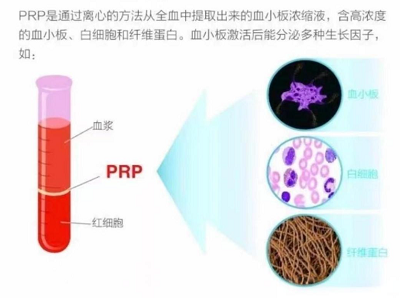 PRP（富血小板血浆）疗法对脱发有帮助吗？