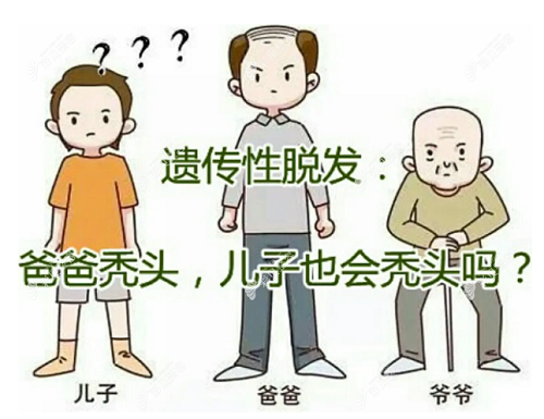 脱发是否会遗传给下一代？