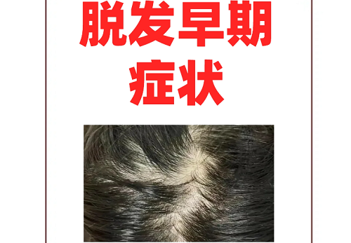 早期发现脱发迹象的重要性是什么？