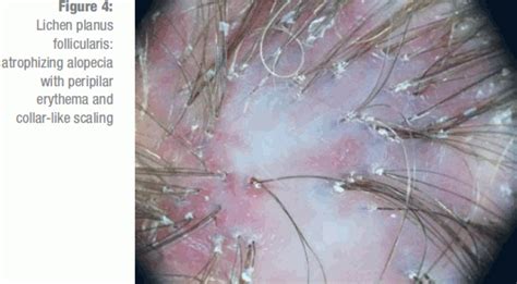 The Diagnosis and Treatment of Hair and Scalp Diseases