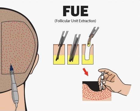 Follicular Unit Extraction (FUE)