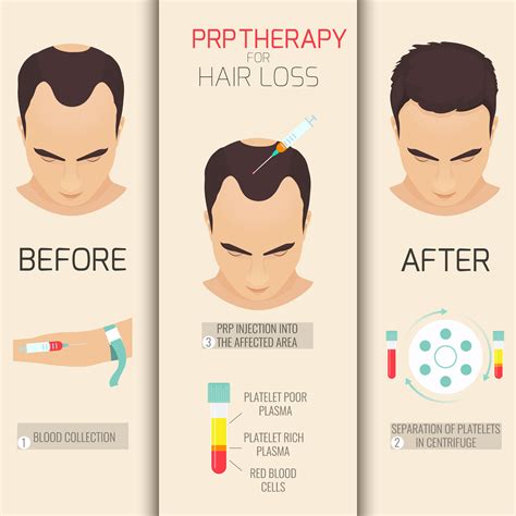 PRP Hair Treatment in In