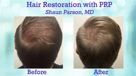 PRP Hair Restoration - The Plastic Surgery Channel